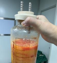 石家庄水动力吸脂手术要做多久？